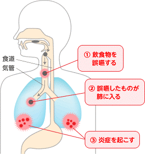 食道気管