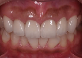 オールセラミッククラウン