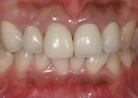 オールセラミッククラウン