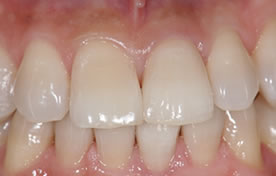 オールセラミッククラウン