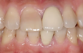 オールセラミッククラウン