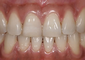 オールセラミッククラウン