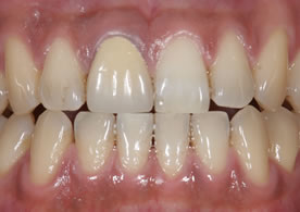 オールセラミッククラウン