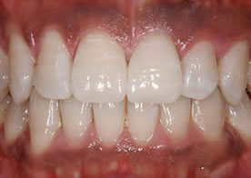 ポーセレンラミネートべニア