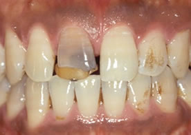 ポーセレンラミネートべニア