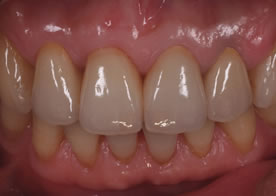 オールセラミックブリッジ