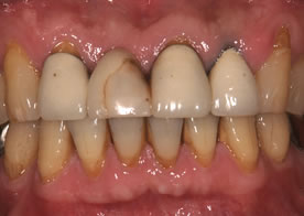 オールセラミックブリッジ