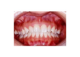 ホワイトニング