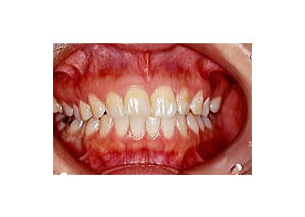 ホワイトニング