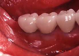 インプラント治療