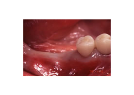 インプラント治療