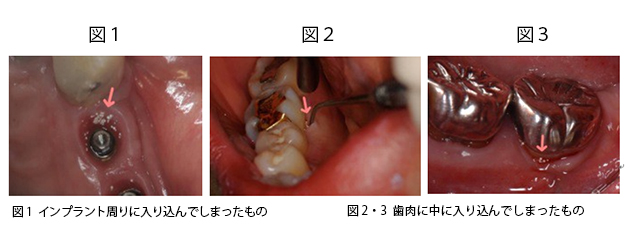 歯磨剤がインプラント周りや歯肉に中に入り込んでしまったもの