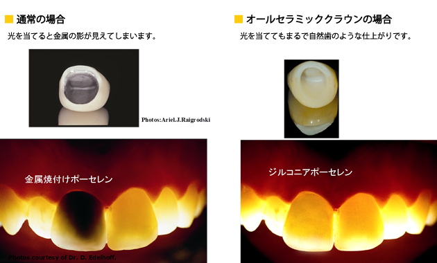 まるで自然歯のような見た目「オールセラミッククラウン」